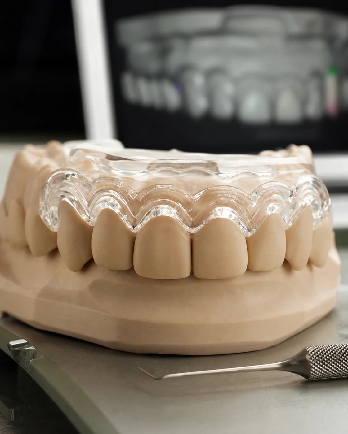 Férula transparente de gingivectomía ajustada sobre un modelo dental
